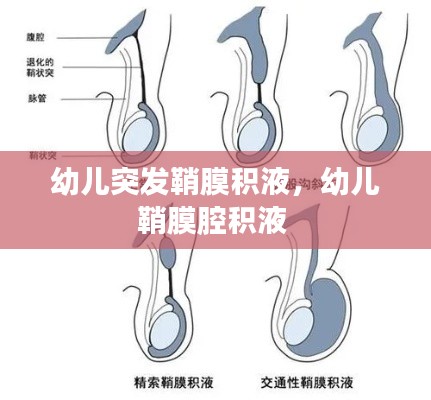 幼兒突發(fā)鞘膜積液，幼兒鞘膜腔積液 