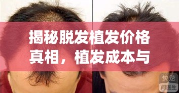 揭秘脫發(fā)植發(fā)價(jià)格真相，植發(fā)成本與最佳方案選擇全解析