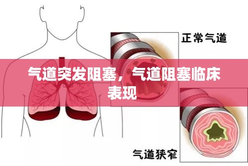 氣道突發(fā)阻塞，氣道阻塞臨床表現(xiàn) 
