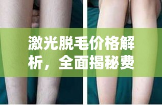 激光脫毛價格解析，全面揭秘費(fèi)用因素！
