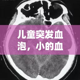 兒童突發(fā)血泡，小的血泡 